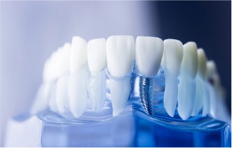 Имплантация зубов в стамоталогии Premier